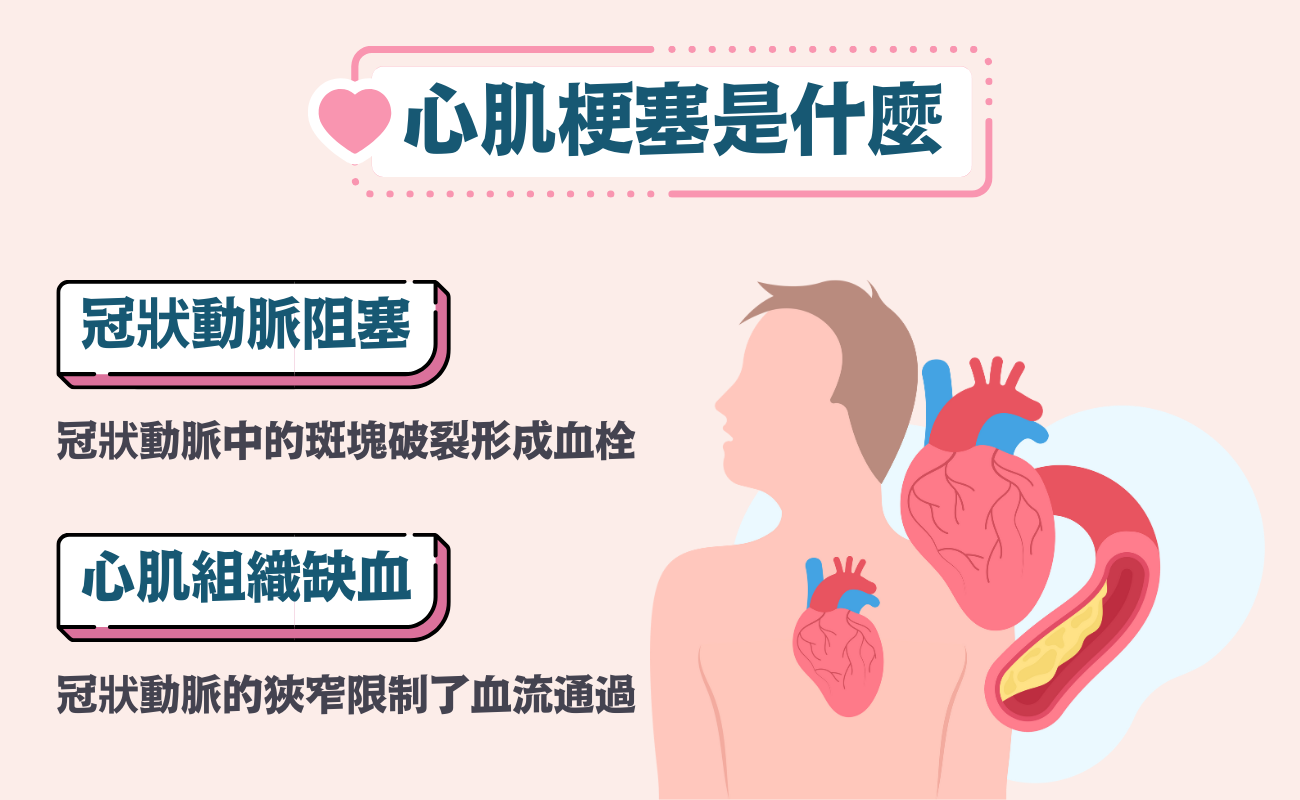 心肌梗塞是什麼